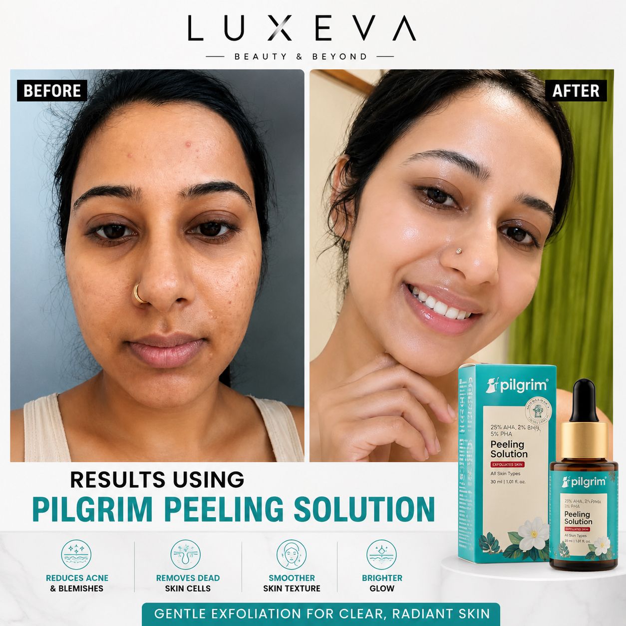 25% AHA, 2% BHA, 5% PHA Peeling Solution